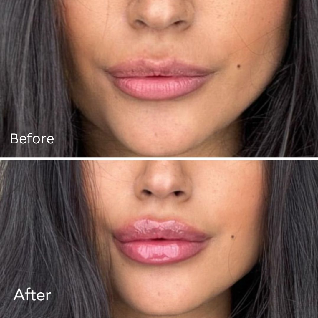 Extremer Lippen-Plumper